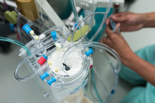 La mininvasività della cardiochirurgia anche nella circolazione extracorporea