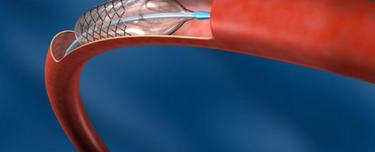 Angioplastica o Bypass